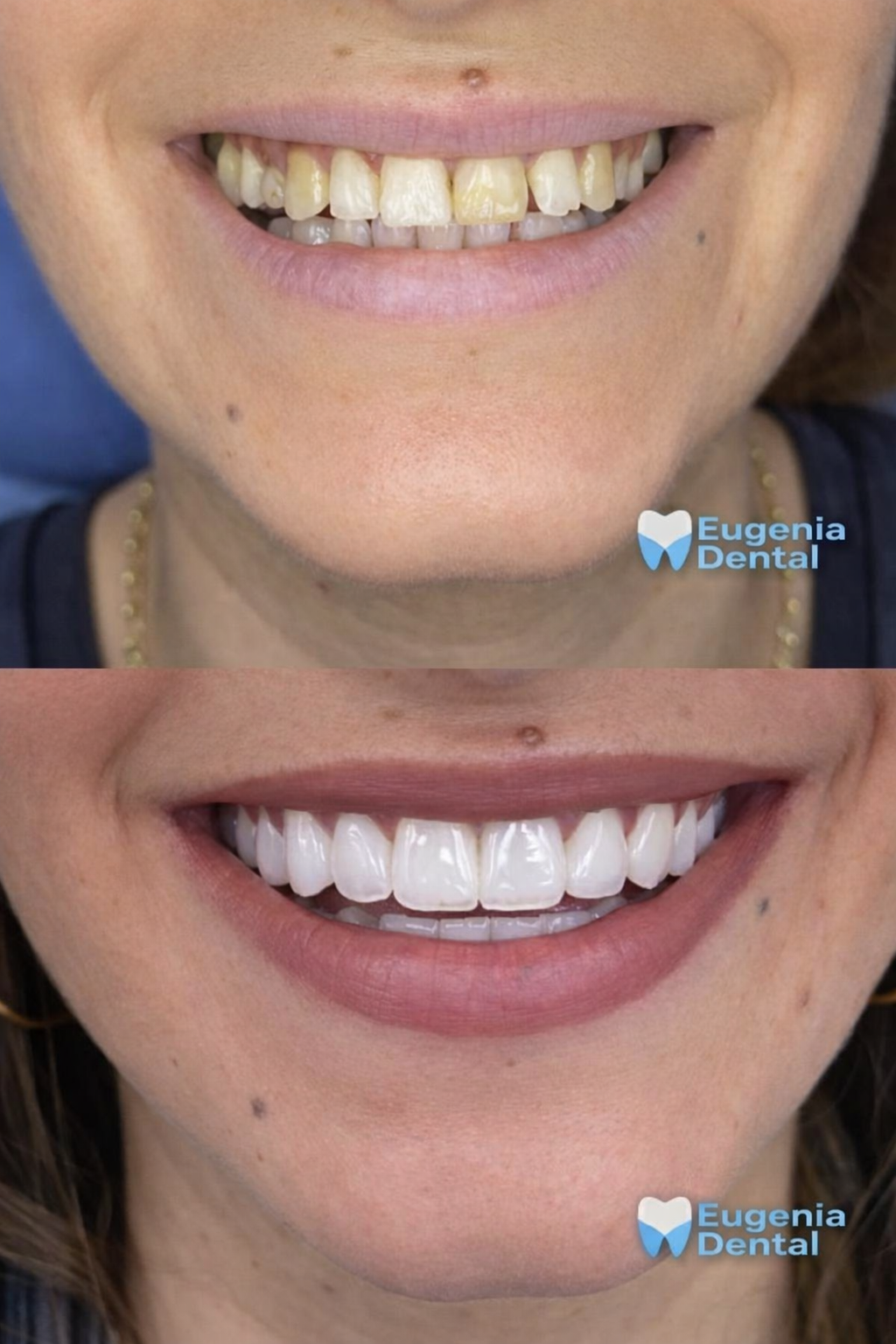 Smile makeover